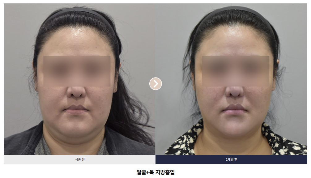 얼굴+목 지방흡입 전후 비교 Case 04