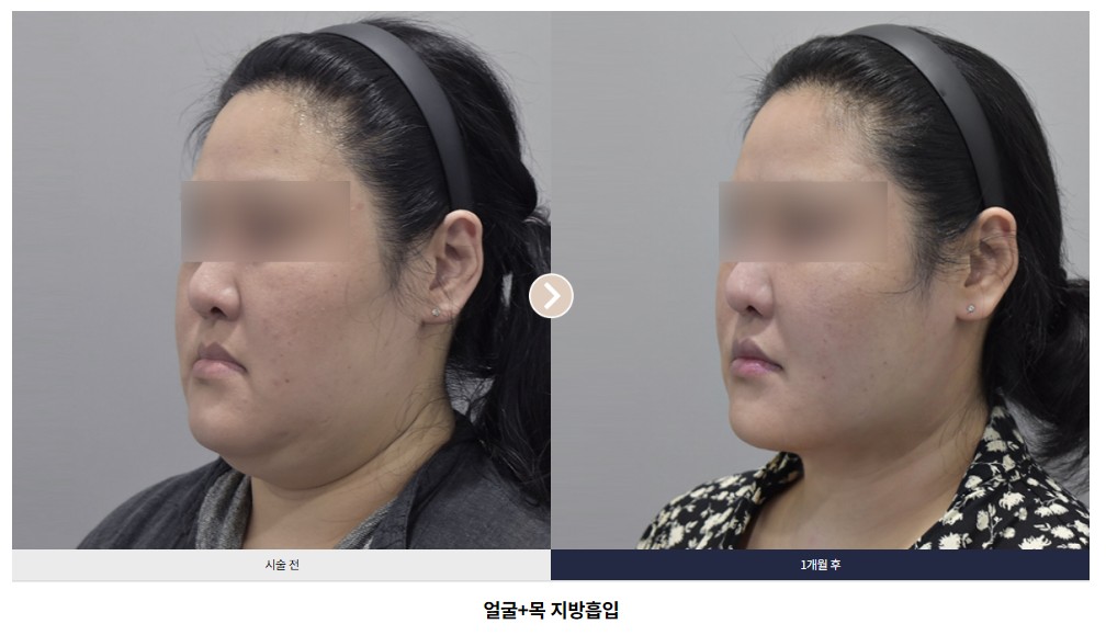 얼굴+목 지방흡입 전후 비교 Case 05